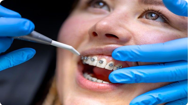 When your braces are first put on, or after adjustments, they apply pressure to your teeth to slowly move them into alignment.